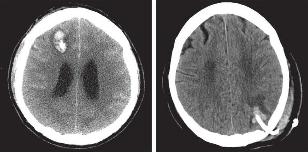 Hemorrhage Associated with Ventriculostomy 547 Illinois, USA) Chi-square test or Fisher s exact tests were used to compare the proportions between two groups, as appropriate.