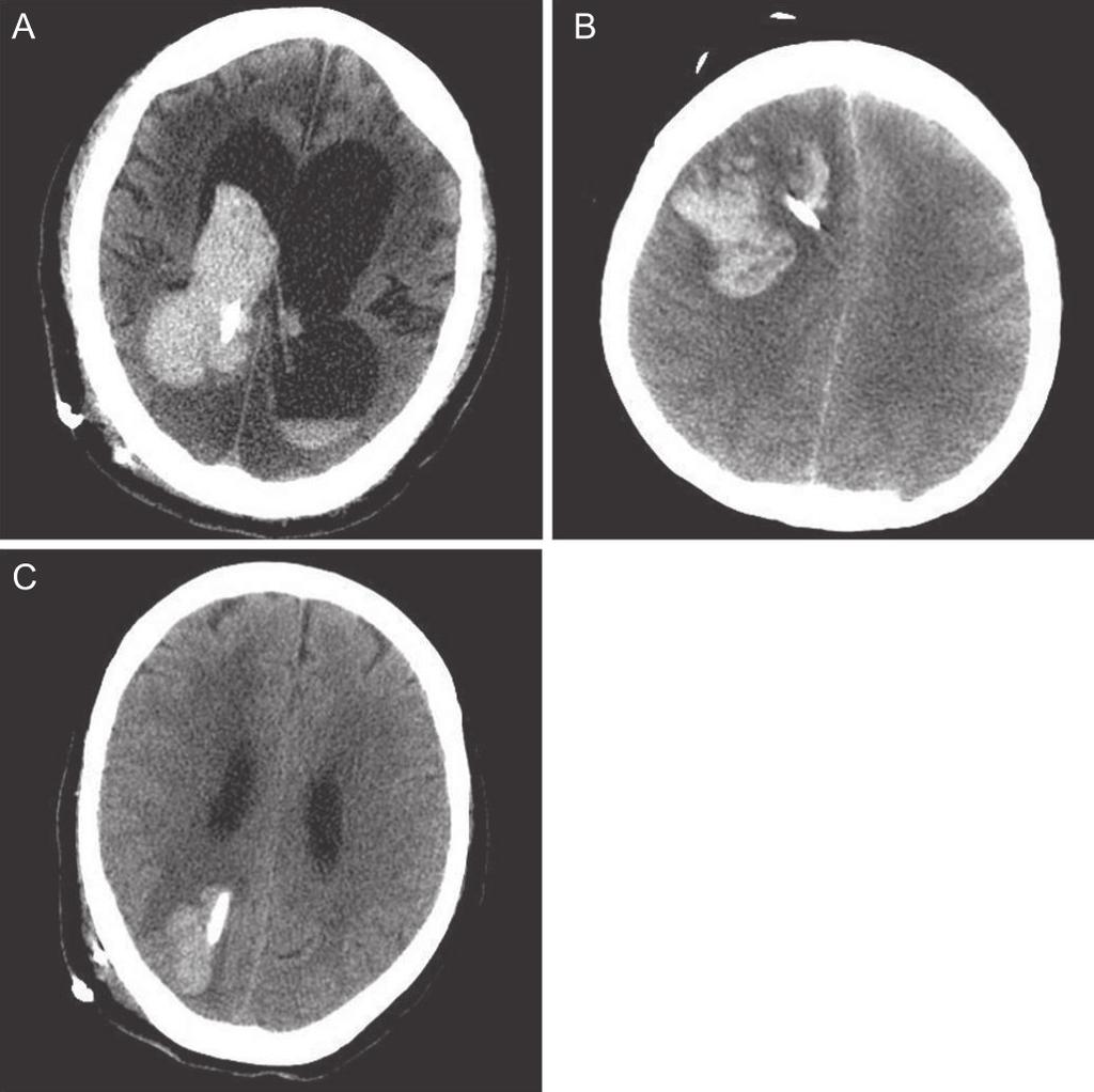Symptomatic hemorrhage, defined as clinically apparent neurological deterioration directly attributable to ventriculostomy, occurred in 5 cases (1.