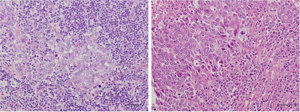 TILs in breast cancer 645 a b Figure 1 Hematoxylin-eosin staining of representative cases of lymphocyte-predominant breast cancer (LPBC), which have typical lymphocyte-rich stroma (a) and