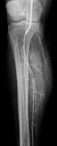 PVI Change in DANA to more distal target Embolization of runoff vessels in calf and
