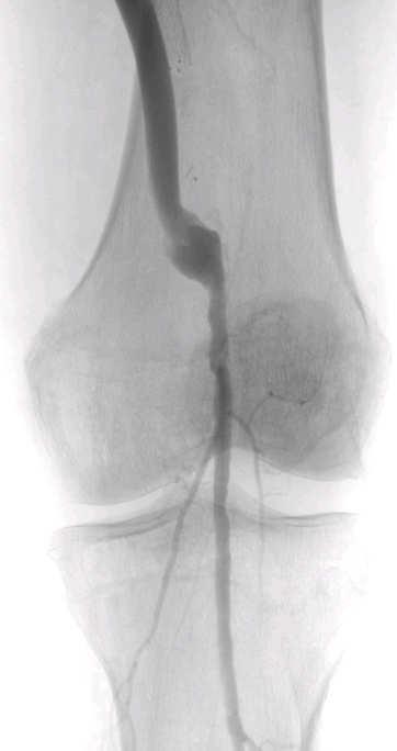 effective revascularization for CLI further tissue loss, infection worsens limb stage
