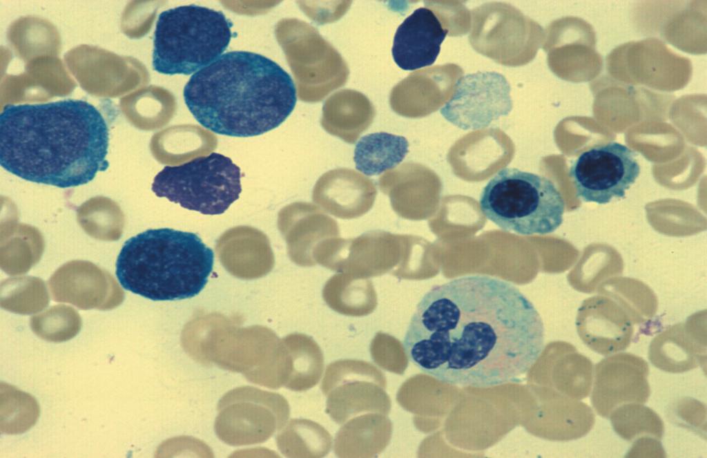 602 Haematology Erythroid Myeloid Megakaryocytic Blood Oval Macrocytes Basophilic stippling Hypogranular neutrophils Hypolobulated neutrophil nuclei Agranular platelets Marrow Nuclear-cytoplasmic