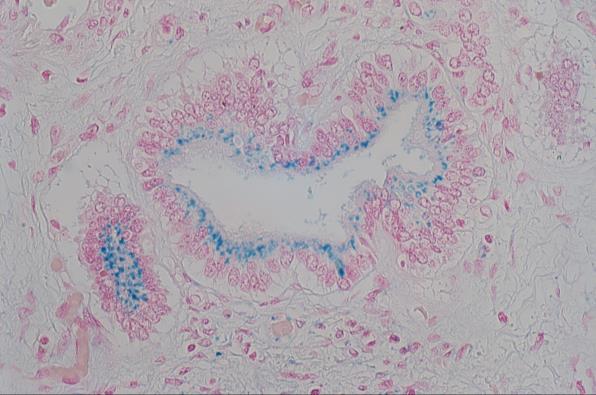 endothelial cells HFE mutation (in HFE HH) Cirrhosis with marked secondary siderosis