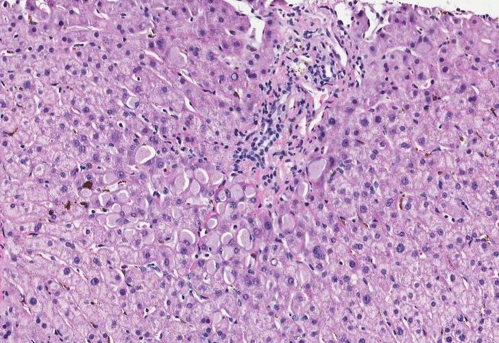 Cytoplasmic inclusions Ground glass appearance Hepatitis B Drugs: Barbiturates, cyanamide