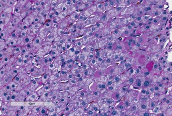 PAS-D stain: partial digestion Special stains: liver pathology Trichrome Iron PAS-diastase Reticulin Copper Other: elastic, PAS, bile Reticulin