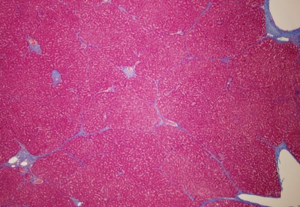 Trichrome stain Staging: viral hepatitis Steatohepatitis Regression of cirrhosis Fibrosis vs.