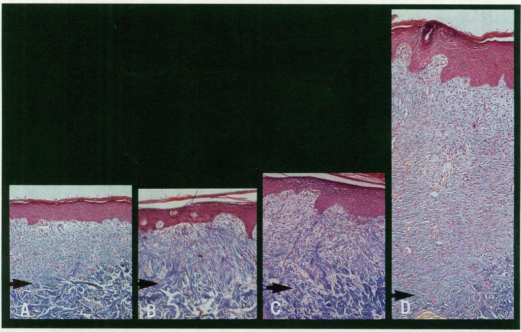 Figure 3. Histologic appearance of 10-d-old wounds.
