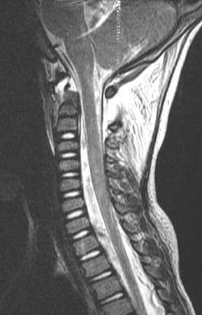 MRI and Clearance Shown to be useful for: Obtunded &/ or unreliable patient with normal radiography and need for cervical