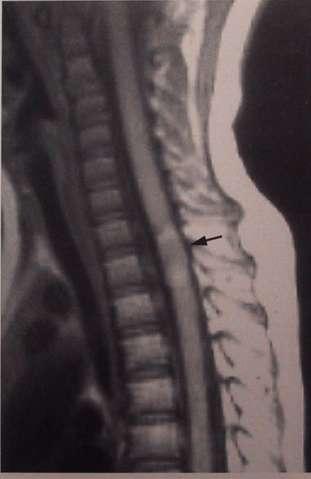 SCIWORA SCIWORA accounts for about 15-25% Cervical spine and TLJ most common Spinal column allows