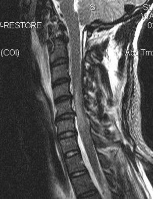 MRI C1-2 Normal Cord edema at C5-6 Correlated with exam (significant