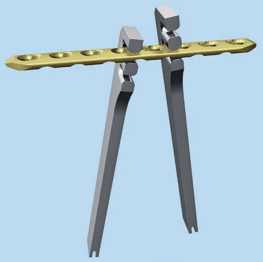 2. Bend the plate Instruments Small fragment 329.040 Bending Iron for Plates 2.4 to 3.5, length 145 mm (for use with 329.050) 329.050 Bending Iron for Plates 2.4 to 3.5, length 145 mm (for use with 329.040) 329.
