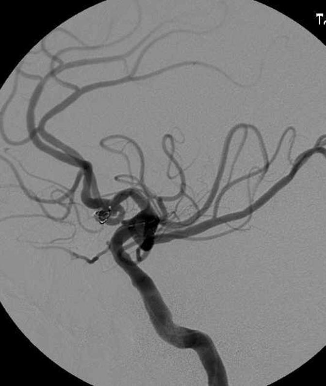 Hong Gee Roh, et al. the patient may suffer from cerebral infartion due to parent artery occlusion or distal thromboembolism.