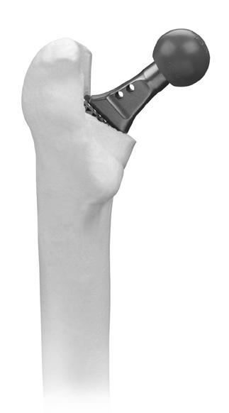 Check the leg length and offset of the femur by referencing the lengths measured prior to dislocation of the hip.