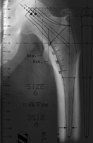 Zimmer M/L Taper Hip Prosthesis 3 Component Size Selection/Templating Preoperative planning for insertion of a cementless femoral component requires at least two radiographic views of the involved