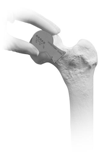Zimmer M/L Taper Hip Prosthesis 5 Surgical Technique Incision In total hip arthroplasty, exposure can be achieved through a variety of methods based on the surgeon s preference.