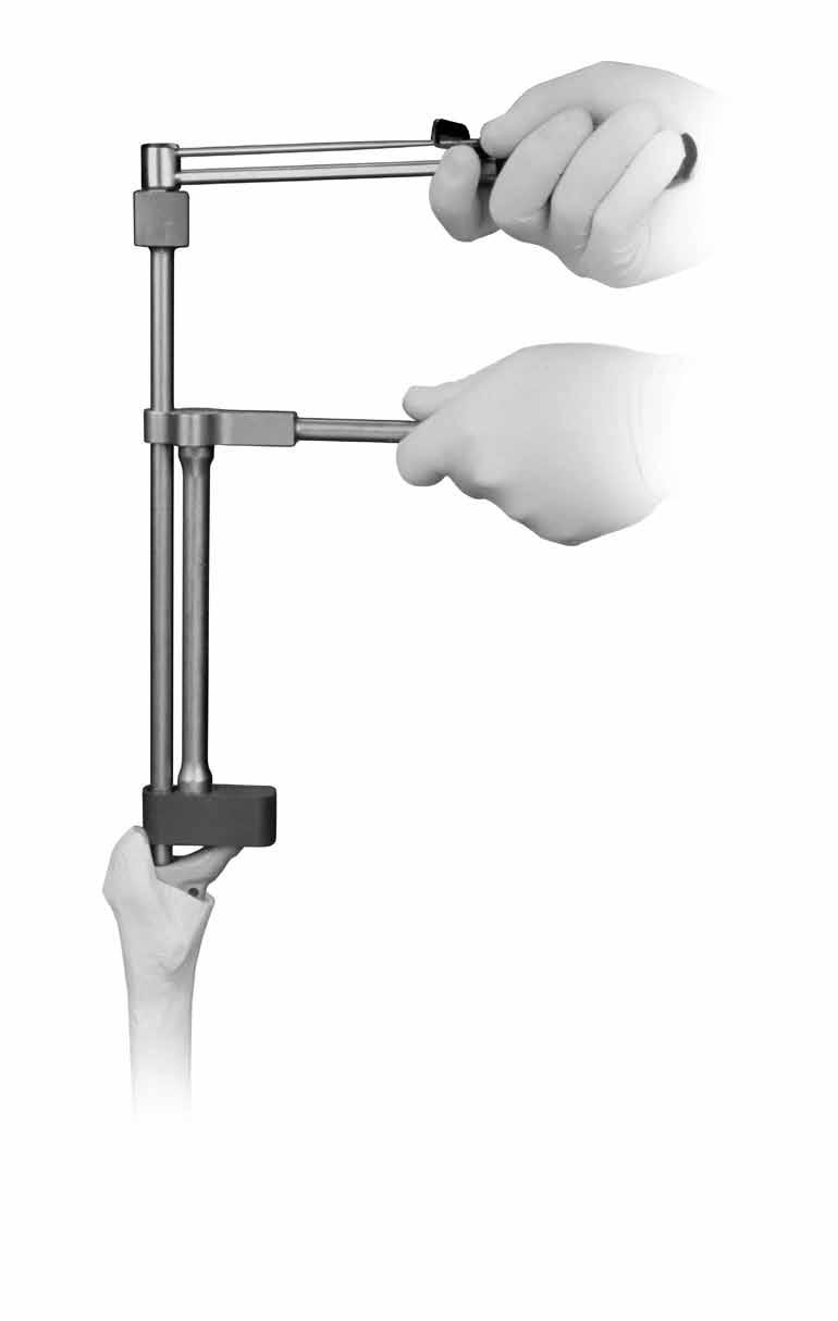 16 ZMR Porous Revision Hip Prosthesis Surgical Technique When this position is acceptable, tightly secure the Proximal Body Provisional to the Distal Stem Provisional by using the Proximal Body