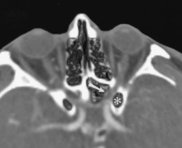 Septations in the sphenoidal sinus assume a vertical orientation. It is important to note whether these bony structures adhere to the carotid canal and optic canal.