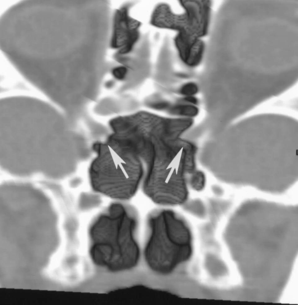 Fig. 9. Three-dimensional volume-rendered images illustrate relationship of optic canal and carotid artery to sphenoidal sinus., 37-year-old man with sinus pain.