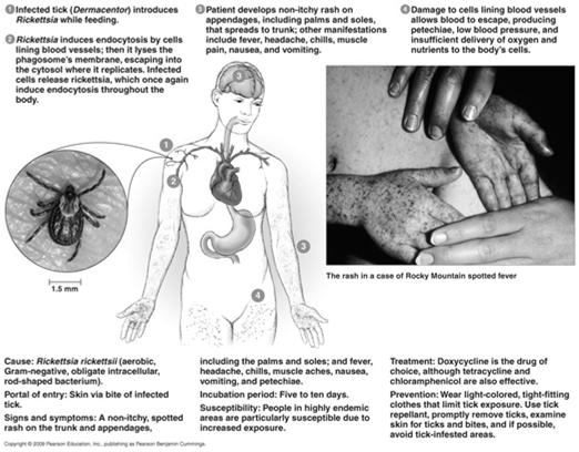 Rocky Mountain Spotted Fever [INSERT DISEASE AT A GLANCE 19.2] 37 Rocky Mountain Spotted Fever (cont.