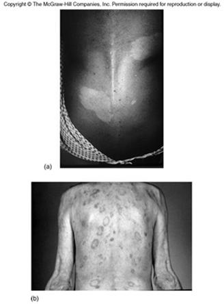 Hansen s Disease (Leprosy) Bacterial infection Chronic and progressive Skin