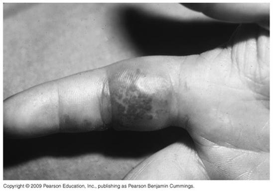Herpes simplex cutaneous lesion