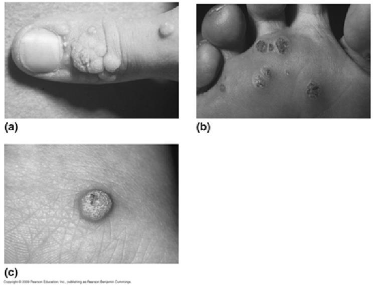 Viral infection Benign Papillomas Nearly everyone is infected Different