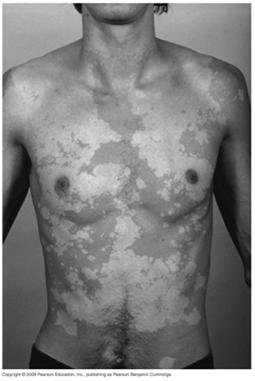 shaving infected hair Pityriasis: Hypo or hyper pigmented scaley skin (affect melanin prod.