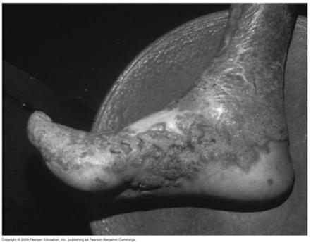 Wound Mycoses Chromoblastomycosis Caused by four species of ascomycete fungi Painless lesions that progressively worsen Phaeohyphomycosis Caused by over 30 genera of fungi Acquired when spores enter