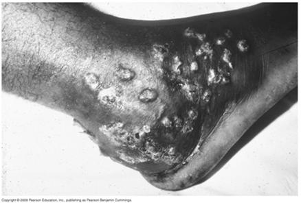 Mycetoma (Madurella mycetomatis) Mycetoma: tumor-like infection of skin, fascia, bones by soil inhabitants 88 Lymphocutaneous Sporotrichosis [INSERT