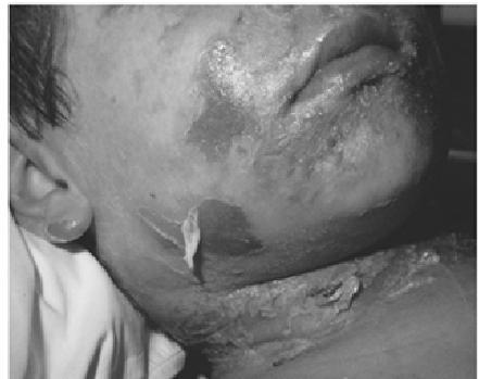 17 Staphylococcal Scalded Skin Syndrome (SSS) Pathogen and virulence factors Some Staphylococcus aureus strains One or two different exfoliative toxins