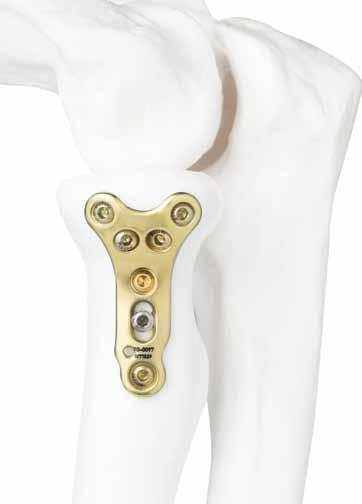 Acumed s Locking Radial Head Plate System provides an innovative and improved method for the treatment of fractures where the radial head is salvageable.
