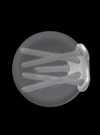The screws are also strategically angled so that they do not break through the articular surface of the radial head or collide with one another, regardless of screw length selected.