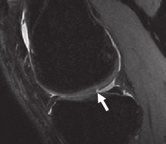 Imaging of the Knee and Hip Joints and fissuring of the articular surface.