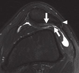 In patients with advanced osteoarthritis, multiple partial-thickness and full-thickness cartilage defects, cartilage delamination, and diffuse cartilage thinning involving opposing articular surfaces