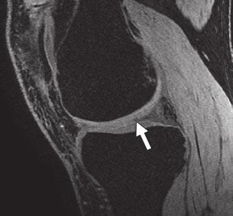 , Sagittal 2D fat-saturated T2-weighted fast spin-echo (FSE) image of knee joint shows subchondral bone marrow edema within anterior lateral femoral condyle (arrow) and posterior lateral tibial