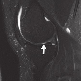 , Sagittal 2D fat-saturated T2-weighted fast spinecho (FSE) image of knee joint from MRI examination shows subtle irregularity of articular cartilage (arrow) on medial femoral condyle.