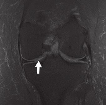 However, few previous studies with surgical correlation have documented the diagnostic performance of MRI for detecting cartilage lesions within the hip joint.