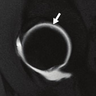 MR arthrography has higher diagnostic performance than MRI for detecting labral tears [100 102].