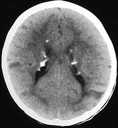 Tuberous sclerosis: evaluation of intracranial lesions There is a correlation between the number and volume of cortical tubers, the age of onset of seizures and the degree of mental retardation: the