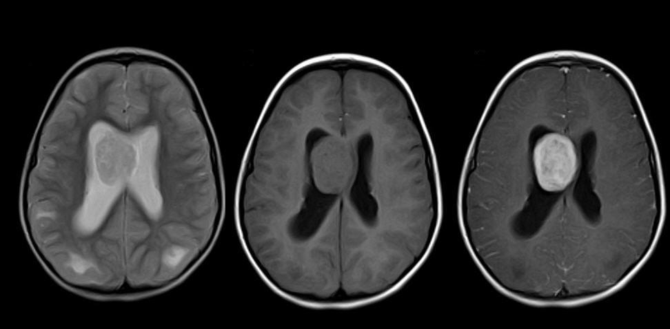 J. Docampo et al. Figure 3 Axial MRI in a 7-year-old female patient. The scan shows a large, ovoid and solid intraventricular mass located on the right lateral ventricle.