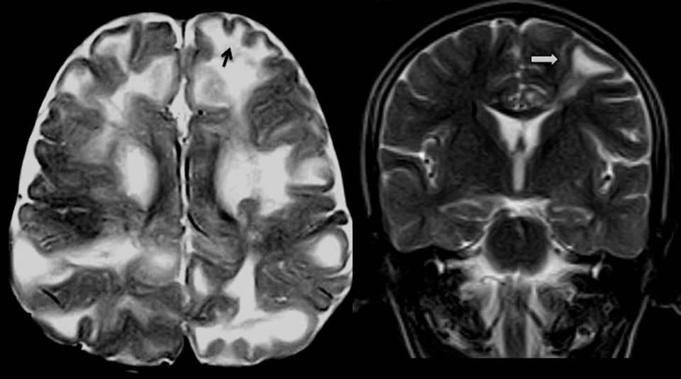 This image is consistent with a subependymal giant cell astrocytoma. Figure 4 Cortical tubers.