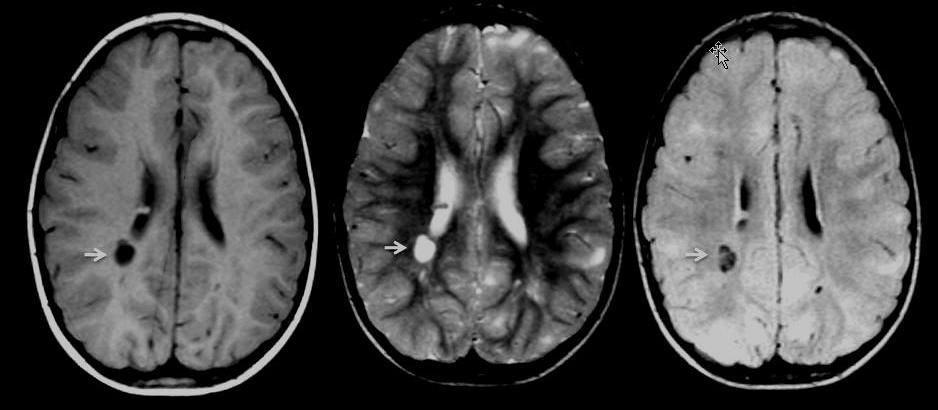 Tuberous sclerosis: evaluation of intracranial lesions mas are located on the wall of the lateral ventricles and their appearance on computed tomography (CT) and magnetic resonance imaging (MRI)