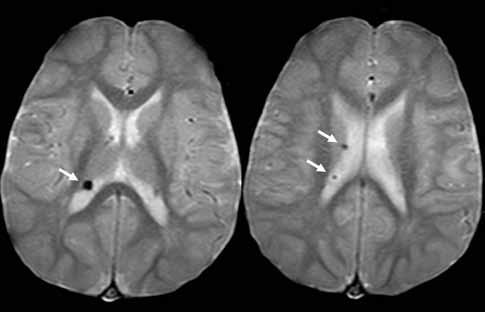 The age of onset is between 8 and 18 years old, and their typical location is near the foramen of Monro. Subependymal astrocytomas may cause obstructive hydrocephaly.