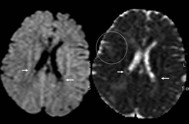 Tuberous sclerosis: evaluation of intracranial lesions FLAIR sequence has an enhanced sensitivity in the diagnosis of cortical tubers both in children and adults.