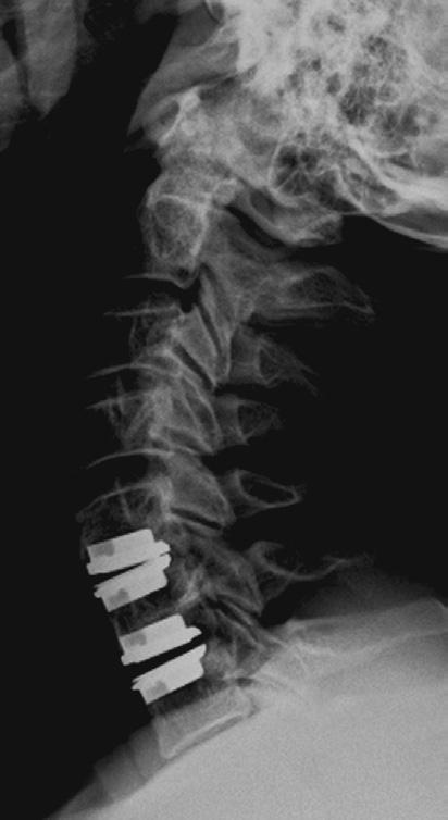CONCLUSIONS Clinical and functional improvement following cervical disc arthroplasty is maintained despite the presence of HO.