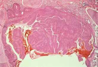 Squamous cell carcinoma (WHO 2004)