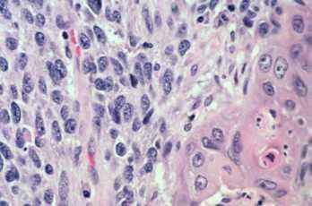 Papillary Clear cell Small cell