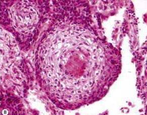 cell carcinoma: Basaloid carcinoma