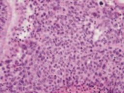 as an adenocarcinoma, solid subtype (B p40; C TTF-1).