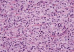 non-small cell carcinoma does not stain for P40 or